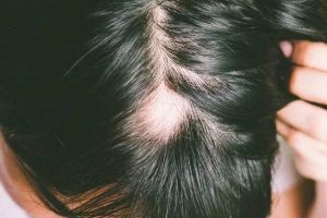 Understanding Alopecia Areata: Causes, Symptoms, and Treatments Hair Repair Clinic