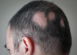 Understanding Alopecia Areata: Causes, Symptoms, and Treatments Hair Repair Clinic