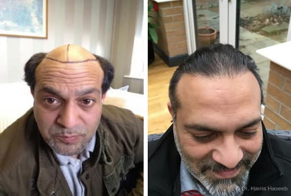 A Crown Full Of Glory: Chad’s Hair Transplant Story