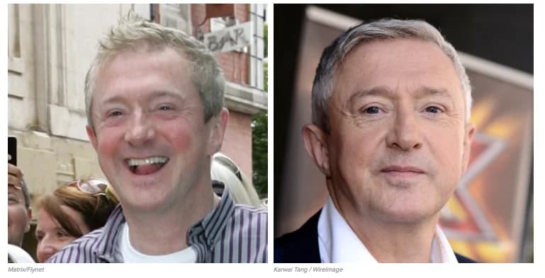 Celebrities’ Hair Transplant Stories