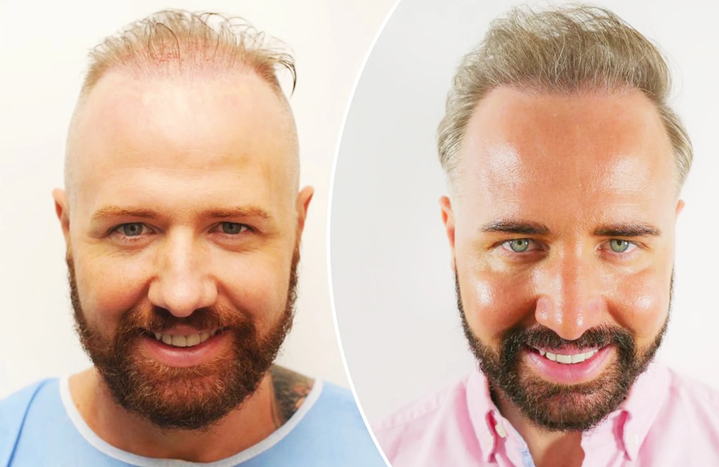 Wayne Rooney Inspired Gogglebox Star Chris Steed to Get a Hair Transplant