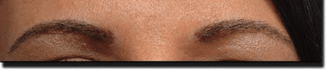 After eyebrow transplant surgery