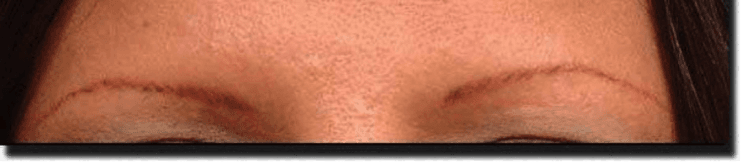 Eyebrow transplant before and after