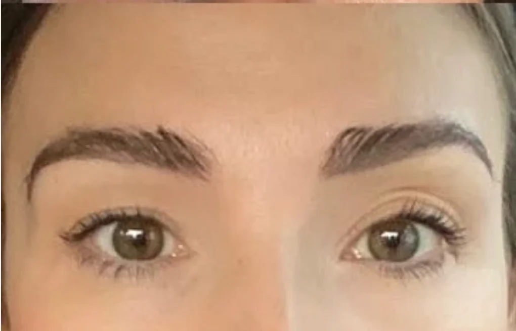 Eyebrow Transplants: Eyebrow Restoration Surgery