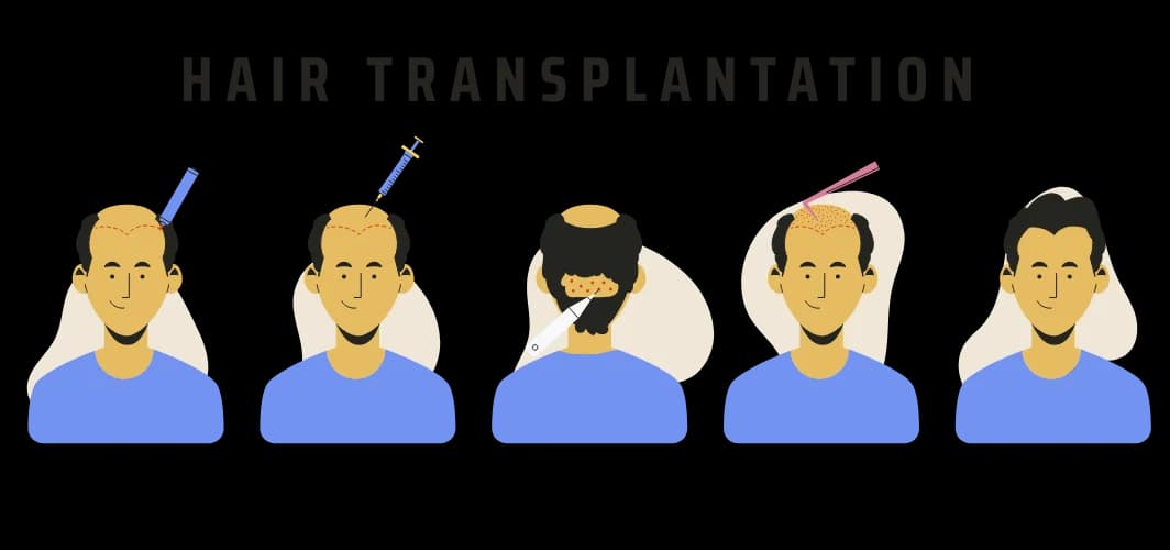 Hair Transplant Cost in UK