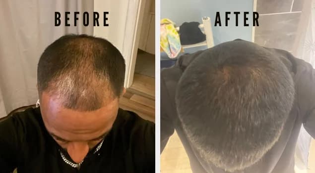 Topical Finasteride 8 months