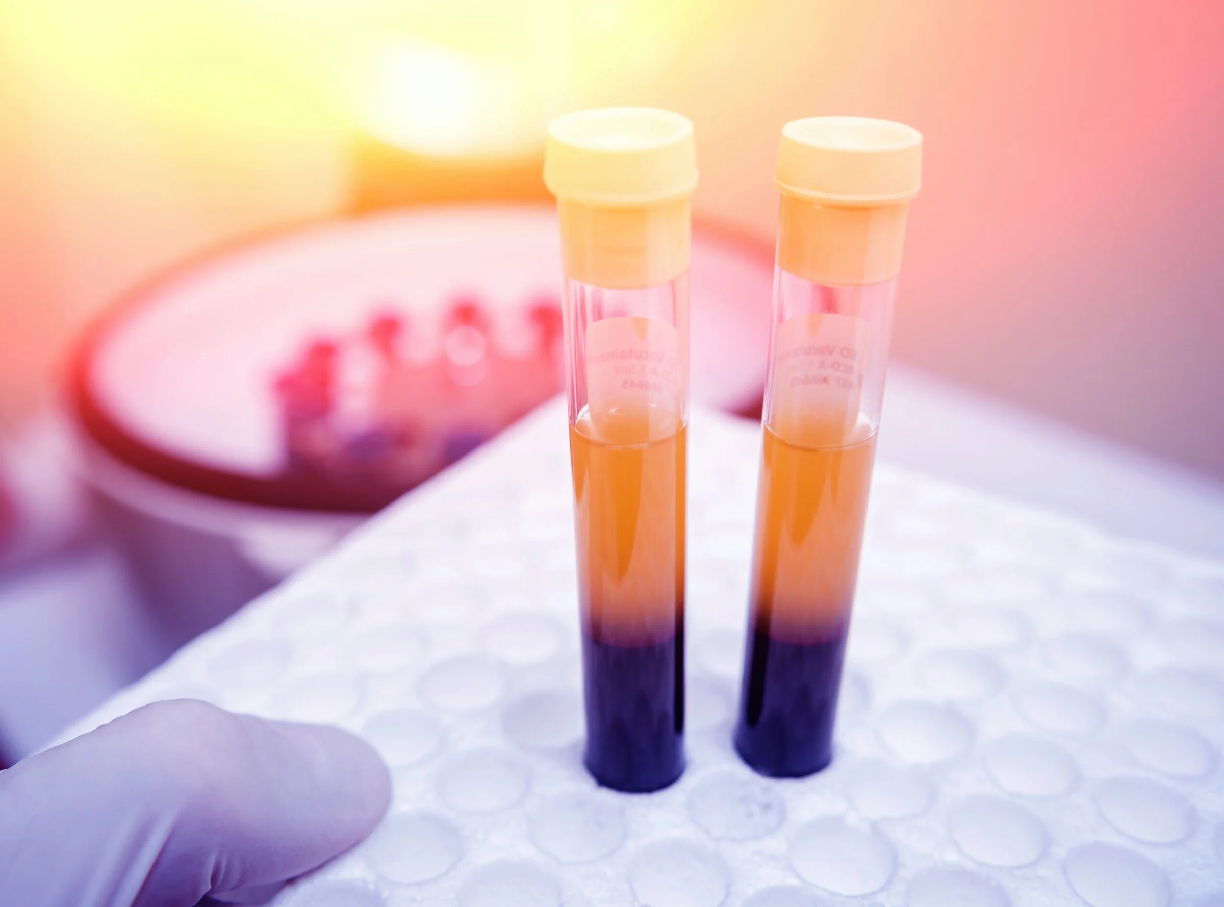 PRP Therapy- Thicken your hair and prevent ongoing hair loss