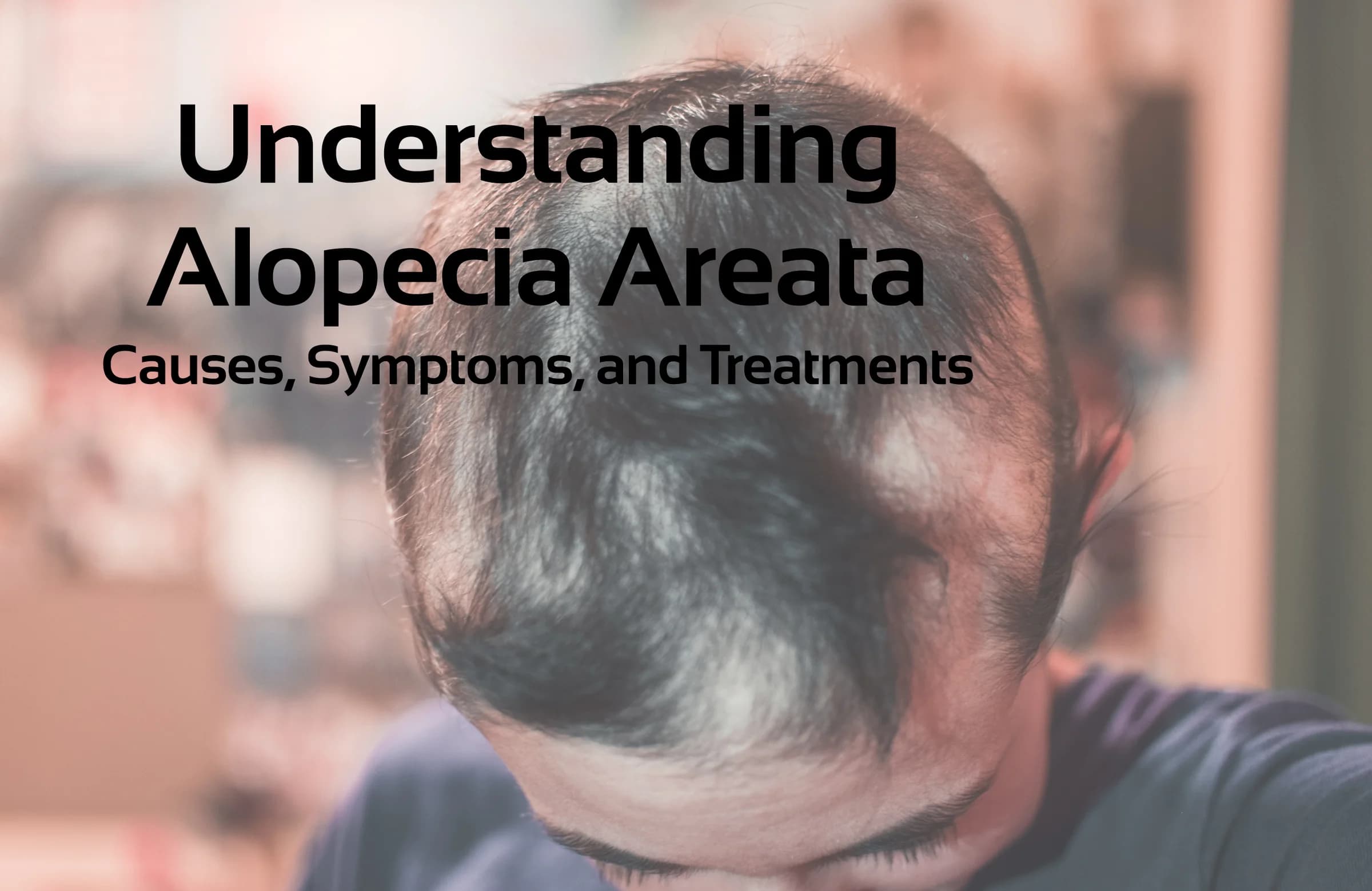 Understanding Alopecia Areata- Causes Symptoms and Treatments Hair Repair Clinic