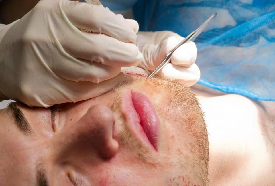 What to expect after a beard transplant?