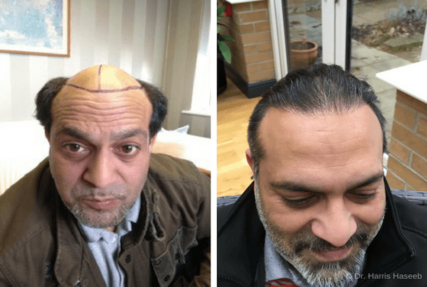 A Crown Full Of Glory: Chad’s Hair Transplant Story