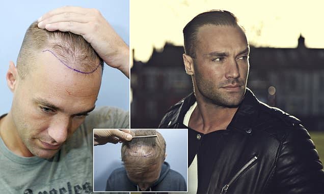 Calum Best reveals his THIRD hair transplant