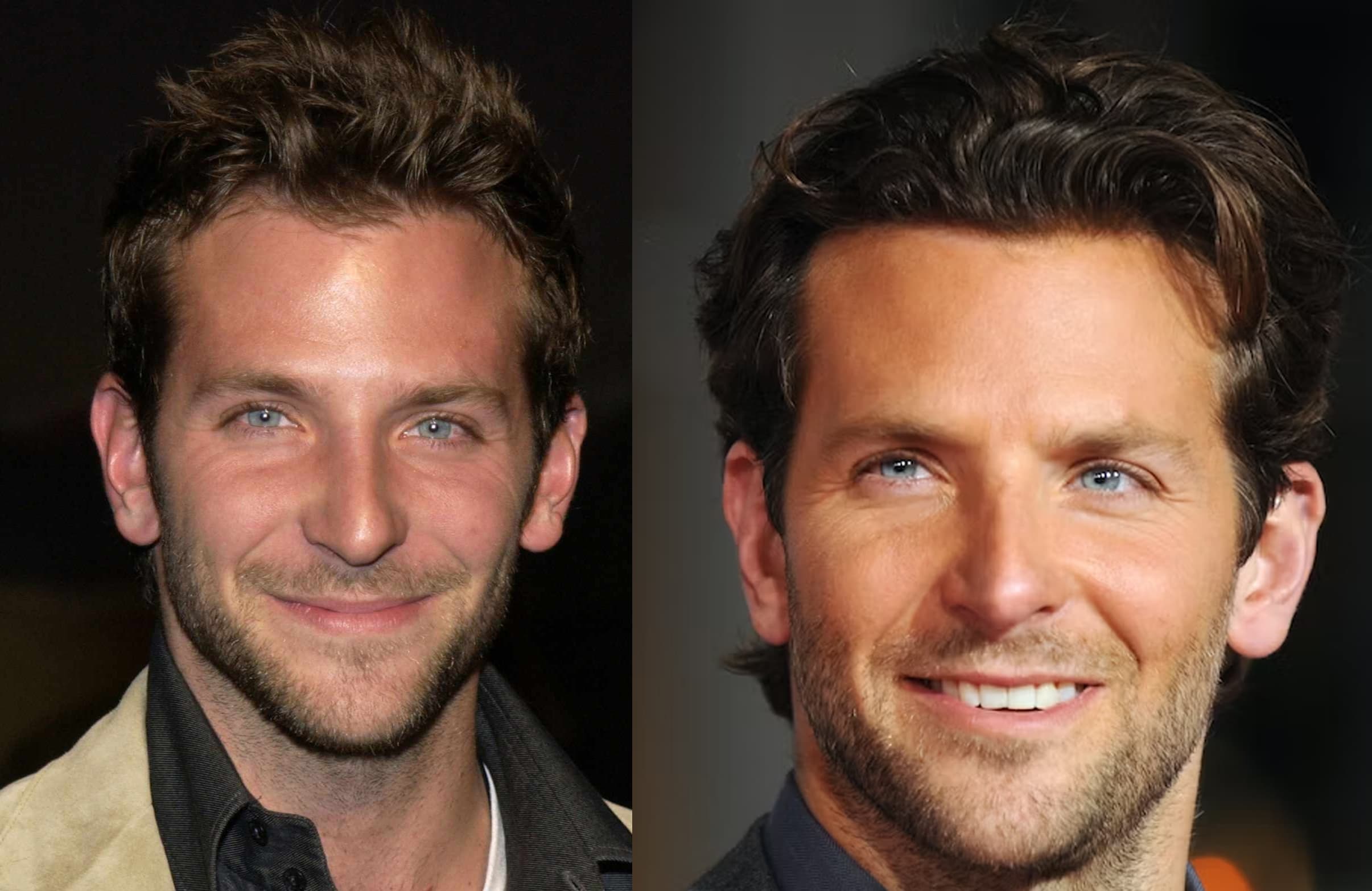 Celebrities Coming out About Hair Transplants Hair Repair Clinic