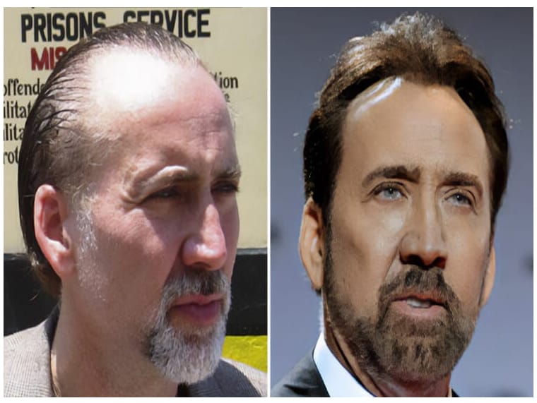 Nicolas Cage Hair Transplant