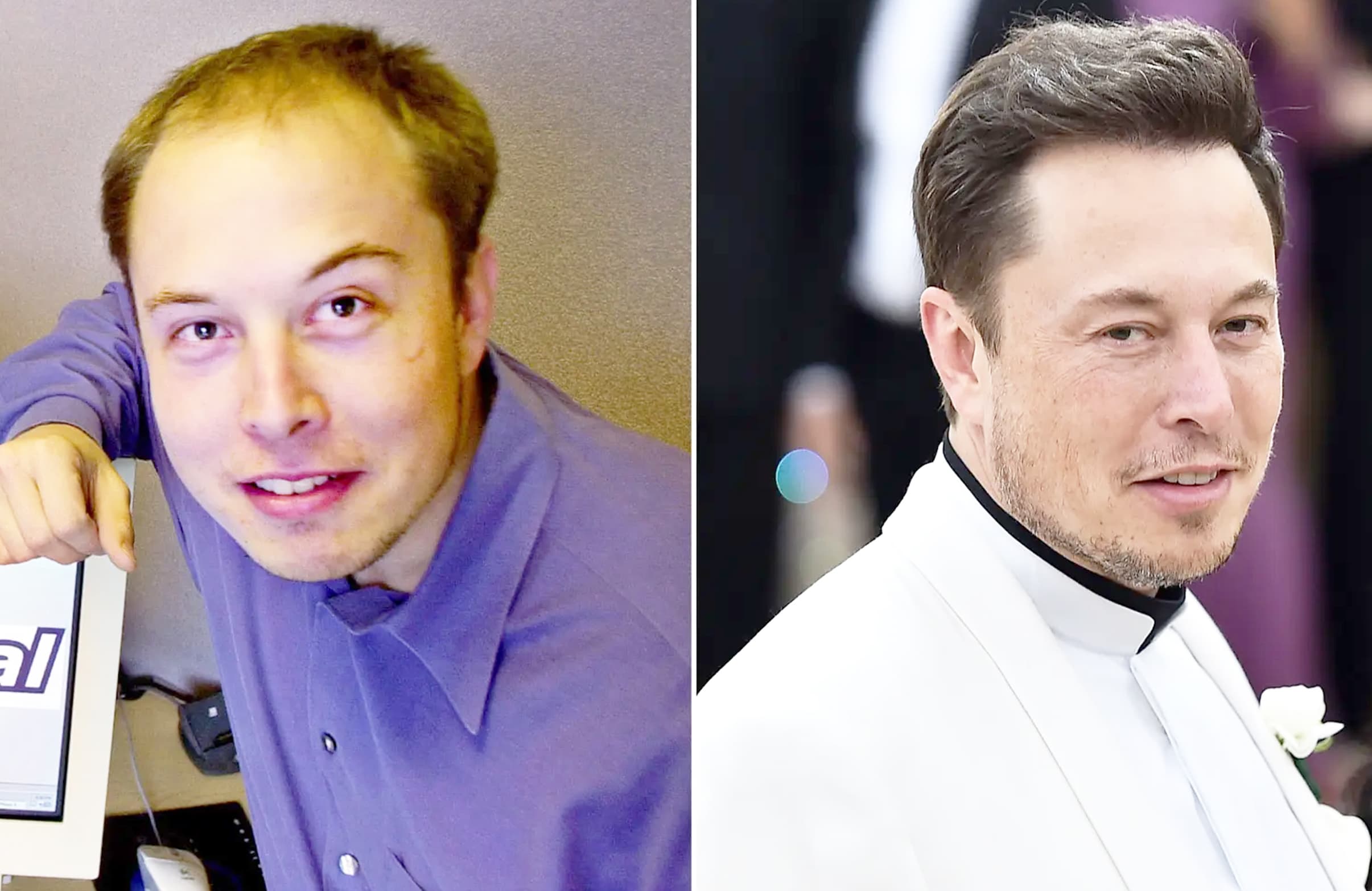 Celebrity Hair Transplants and Male Baldness