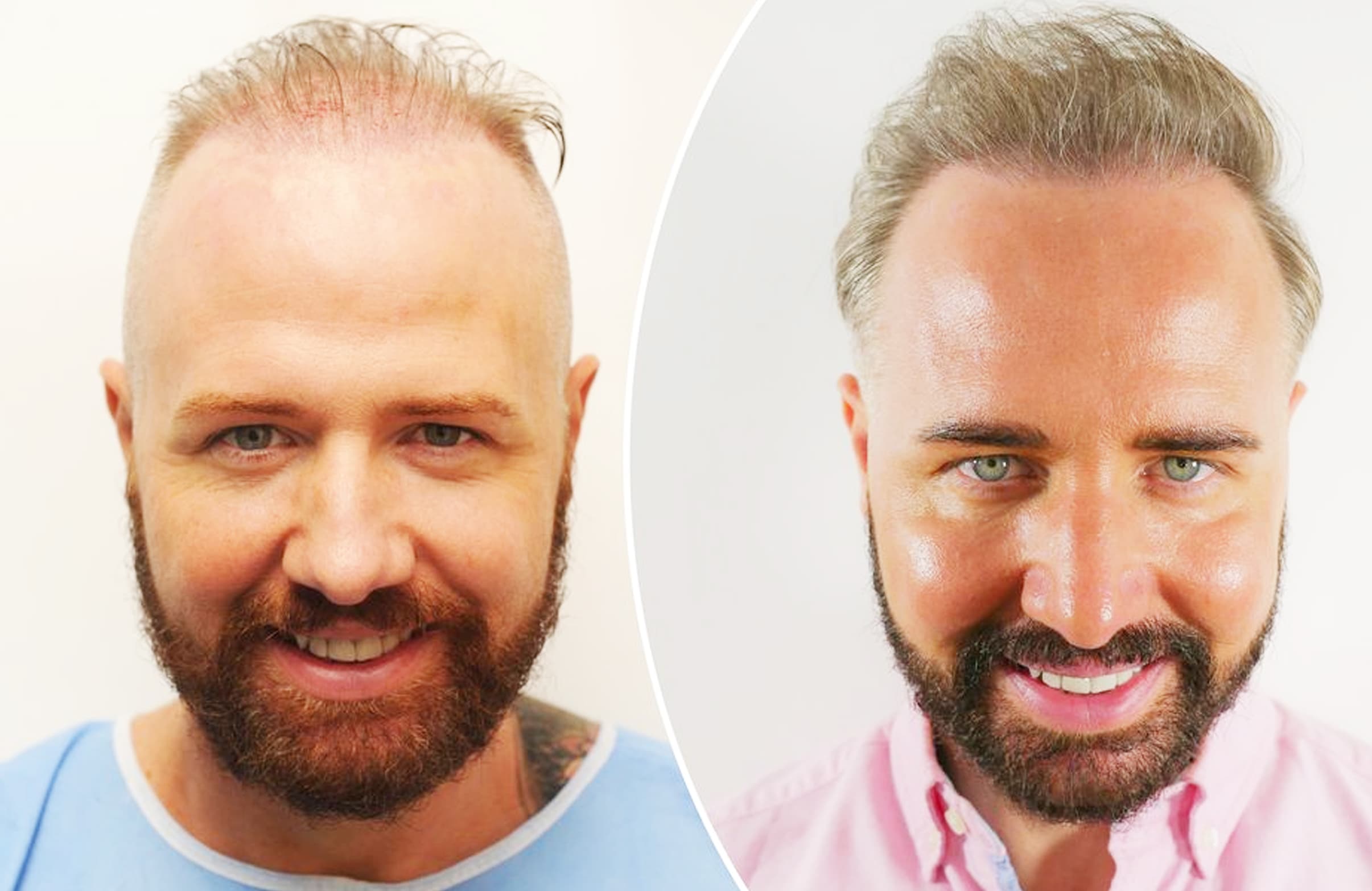 Wayne Rooney Inspired Gogglebox Star Chris Steed to Get a Hair Transplant