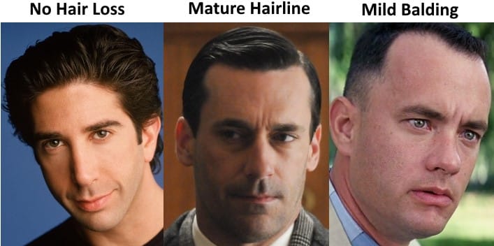 The Mature Hairline Explained - Are You Balding or Maturing?