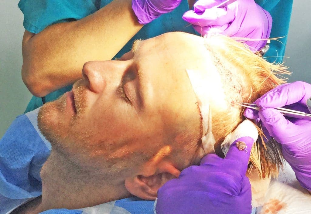 Hair Transplants & Tinder – The Surprising Facts