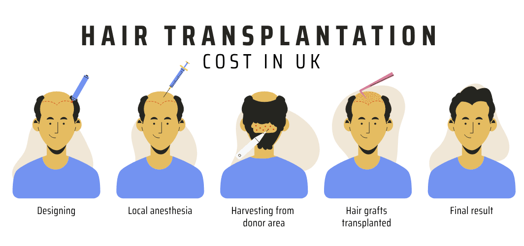 Hair Transplant Cost in UK