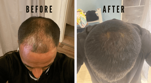 Topical Finasteride 8 months