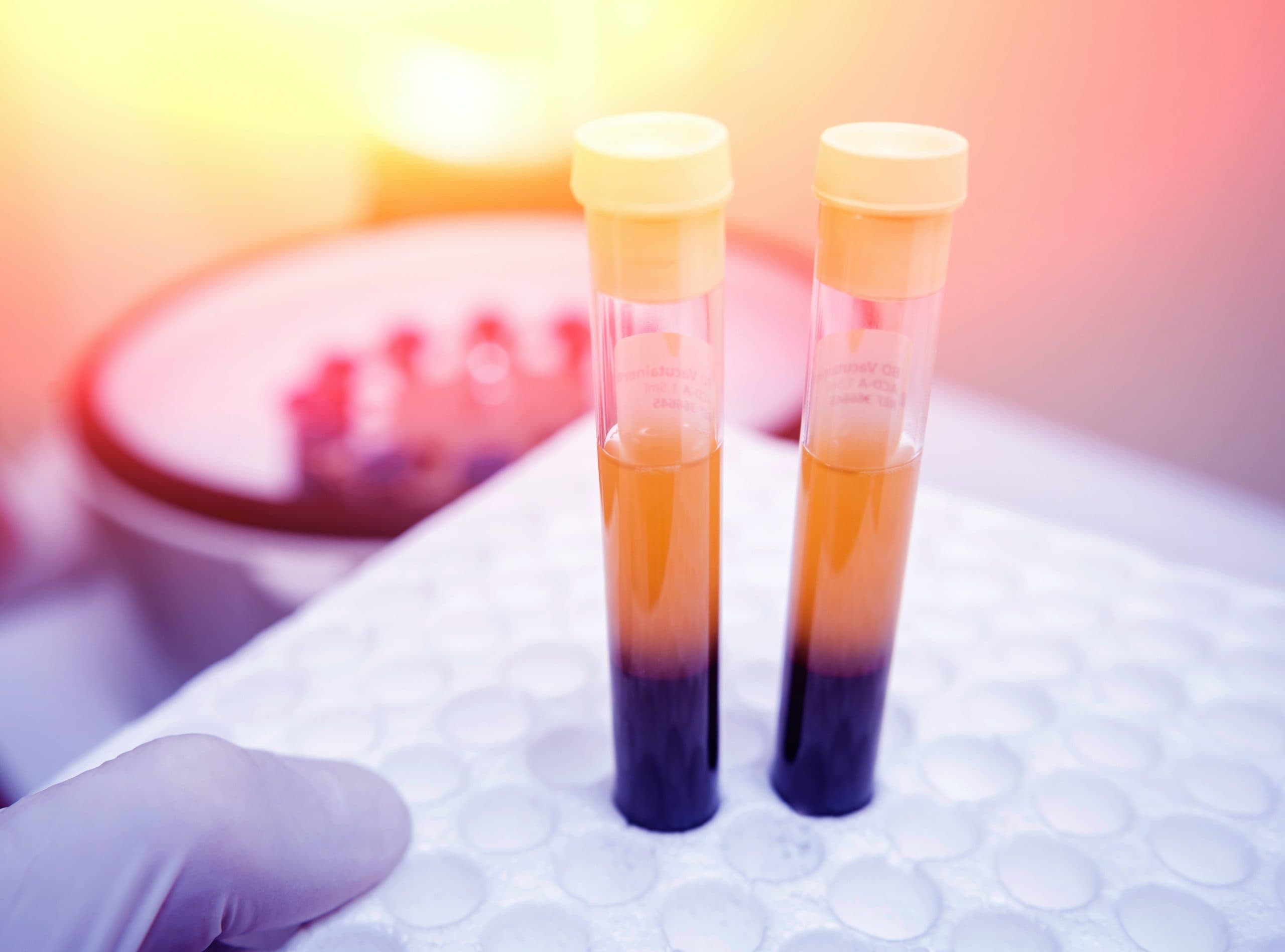 PRP Therapy- Thicken your hair and prevent ongoing hair loss