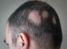 Understanding Alopecia Areata: Causes, Symptoms, and Treatments Hair Repair Clinic