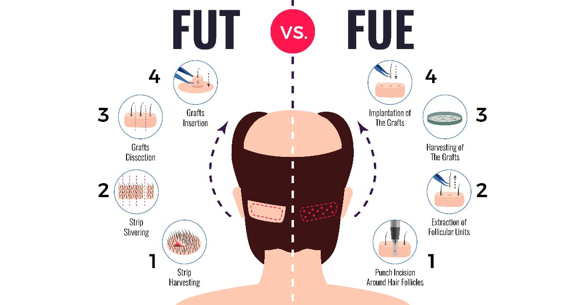 What’s the difference between FUT and FUE?