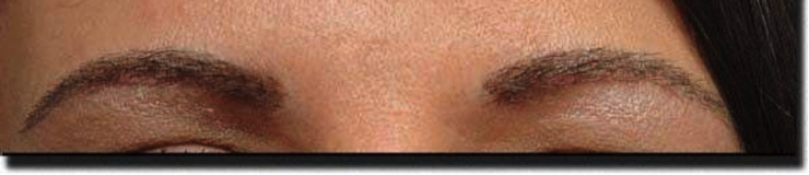 After eyebrow transplant surgery