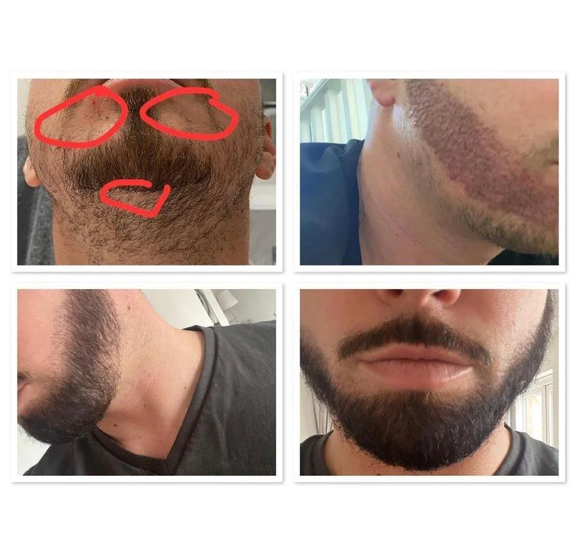 Beard transplant patient