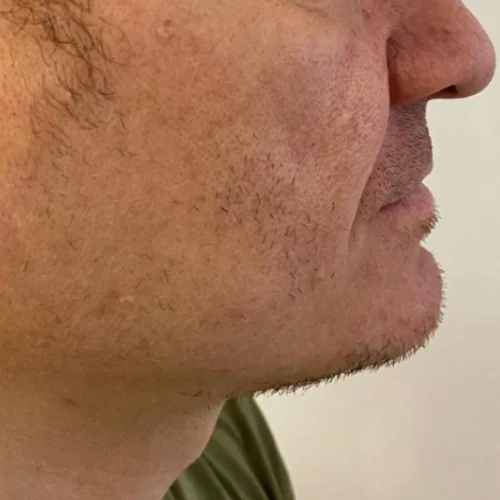 Beard transplant patient