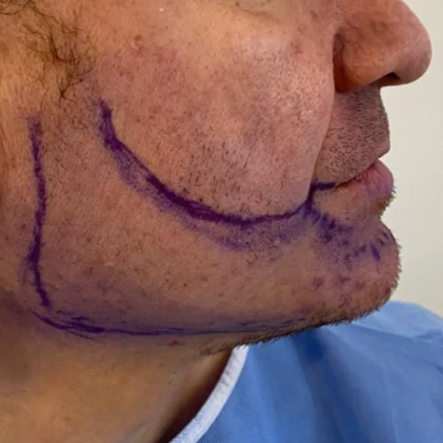 Beard transplant patient