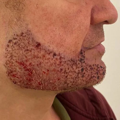 Beard transplant patient