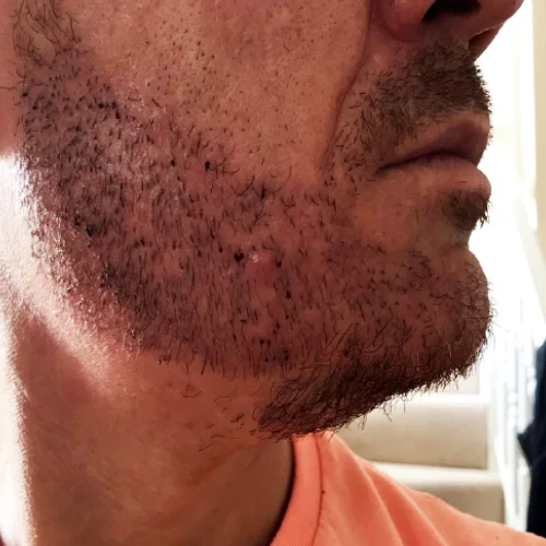 Beard transplant patient