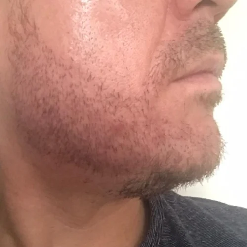 Beard transplant patient
