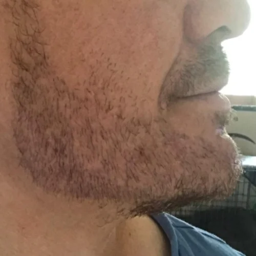 Beard transplant patient