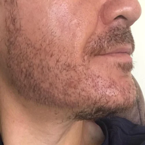Beard transplant patient