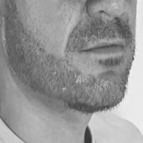 Beard transplant patient