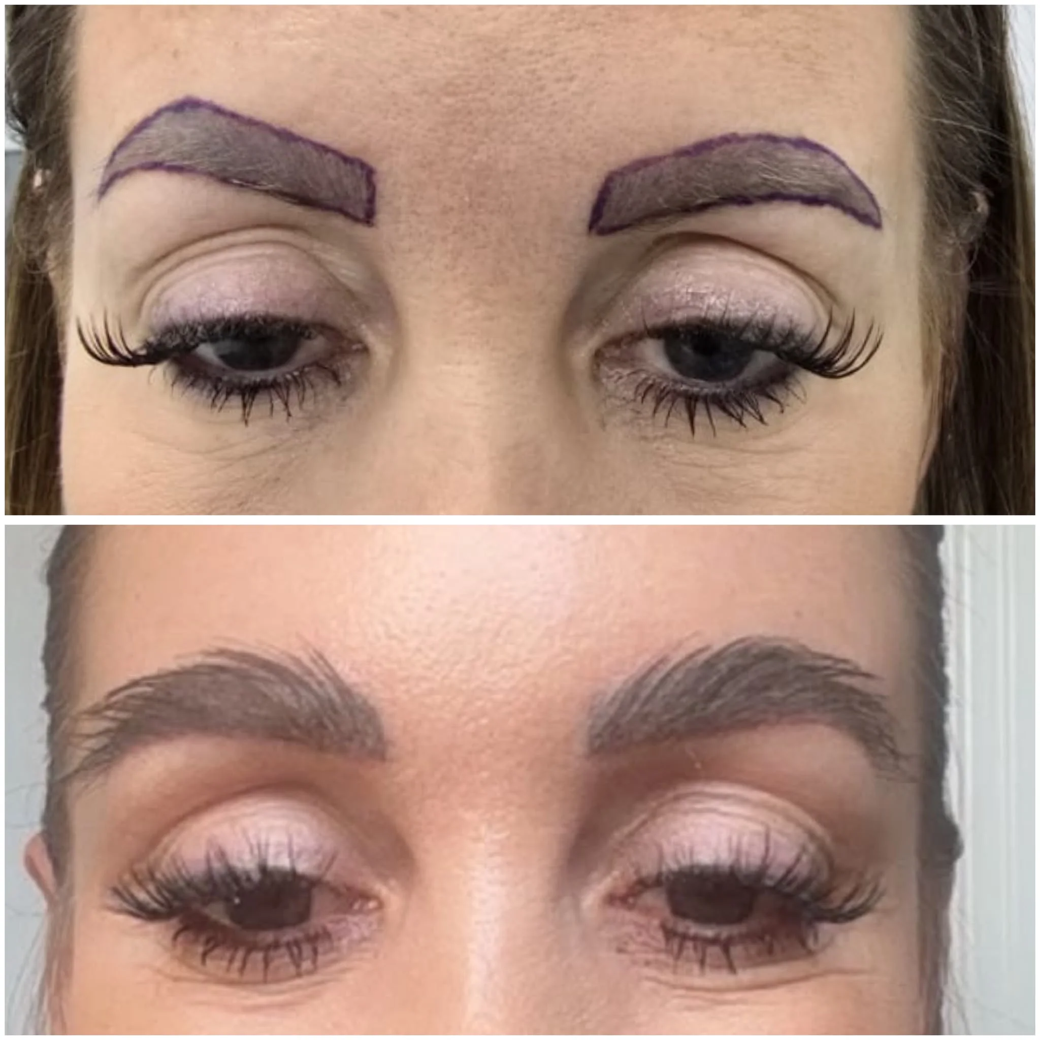 Eyebrow transplant patient photo