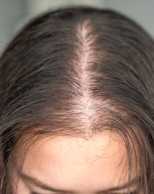 Hair loss from hormonal changes, age, stress or medical history
