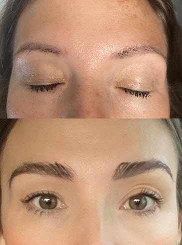 Eyebrow transplant before and after