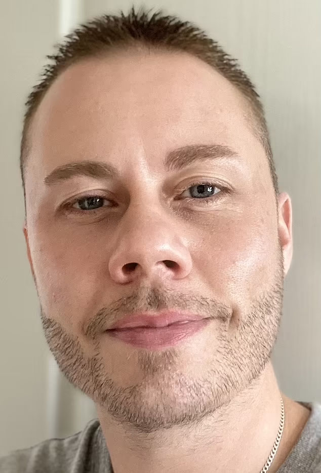 Lee Brown before his beard transplant