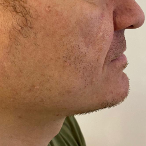 Beard transplant patient a1