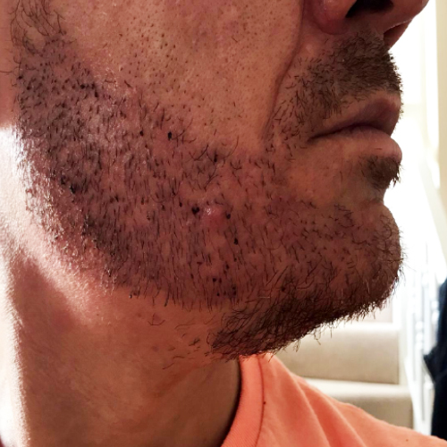 Beard transplant patient a4