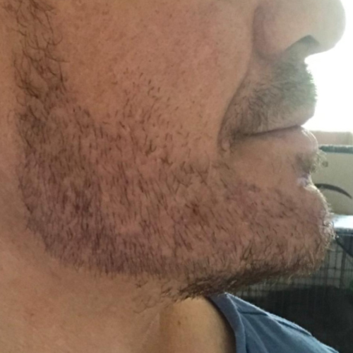 Beard transplant patient a6